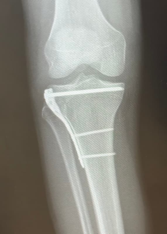 X-ray of the founder's surgical repair after a tibial plateau fracture, October 2025