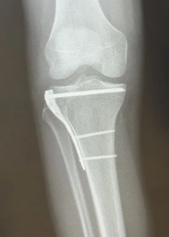 X-ray of Daniel’s surgical repair after a tibial plateau fracture, October 2025